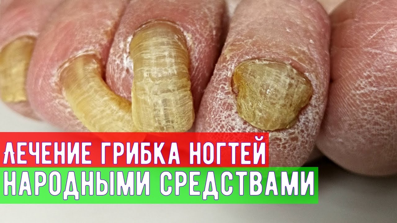 Грибок народное лечение от врача дерматолога - YouTube