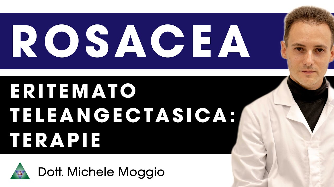 TERAPIA ROSACEA ERITEMATO TELEANGECTASICA | Dott. Michele Moggio