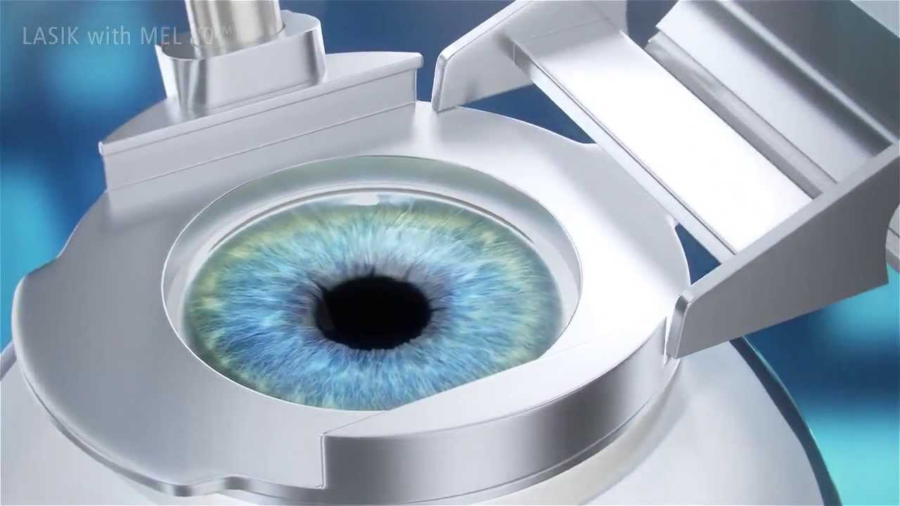 ReLEx SMILE vs Lasik - YouTube