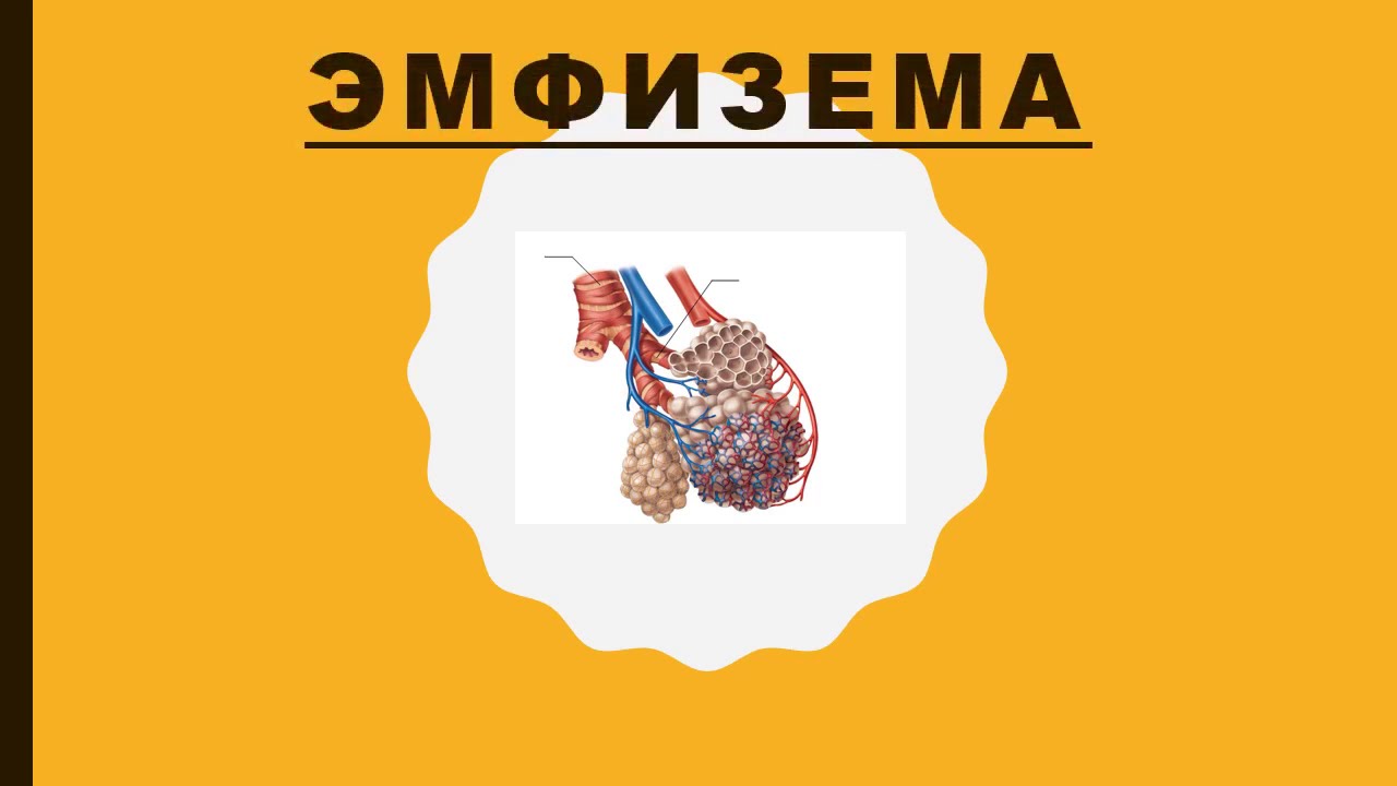 Эмфизема легких - этиология, патогенез, основные симптомы.