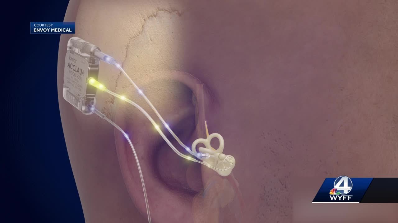Wireless Cochlear Testing MUSC tests new wire-free cochlear implant: volunteers needed - YouTube