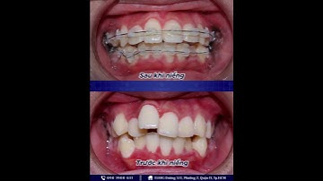 Niềng răng khấp khểnh trong 18 tháng  #nhakhoaaumy #nhakhoauytin #niengrang  #invisalign