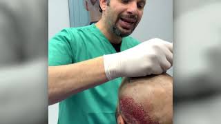 تابع أسرار في زراعة الشعر