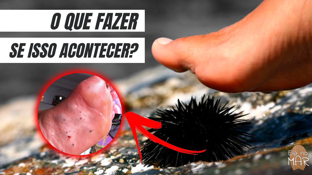 [147] Ferimento por ouriço do mar: o que fazer se tiver contato com ...