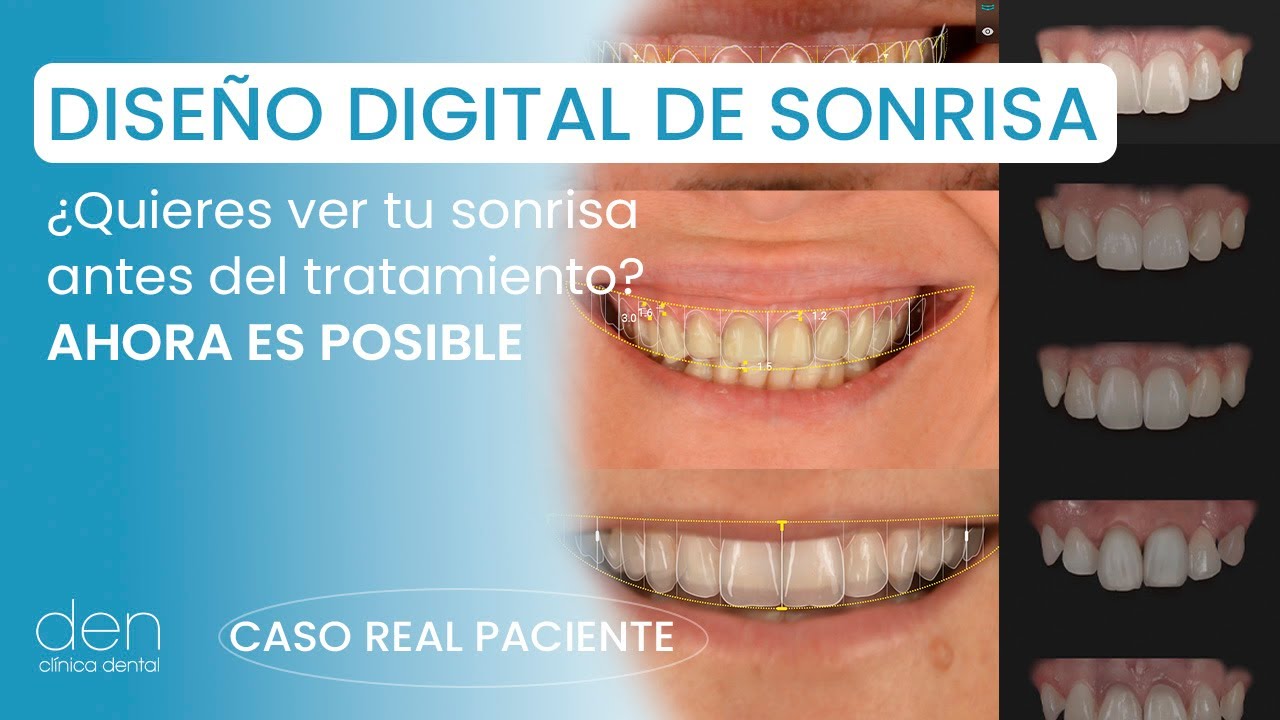 ¿Qué es SmileCloud y cómo funciona? | Diseño Digital de Sonrisa con IA para Odontólogos