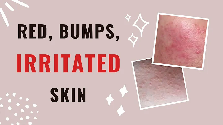 Treat Redness, tiny Bumps, SKIN IRRITATION on face...