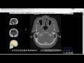 Tomografía Computada de Cabeza para Anatomía Parte 1