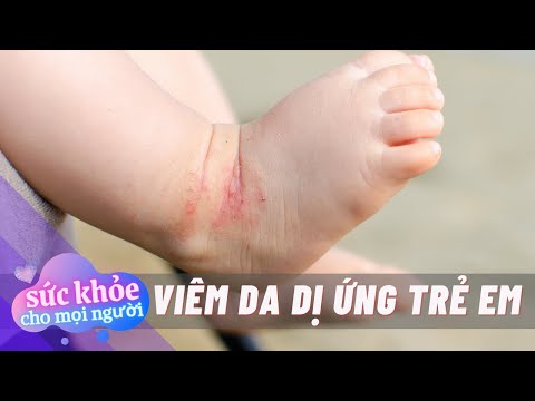 Sức Khỏe Cho Mọi Người Viêm Da Dị Ứng Ở Trẻ Em
