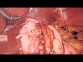 Toupet Fundoplication Animation with Actual Surgical Footage