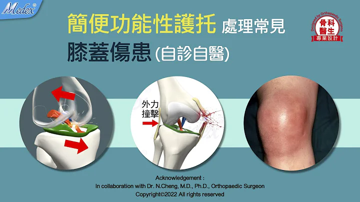 簡便功能性護托處理常見膝蓋傷患 (K02b,K16b,K32b) - 天天要聞