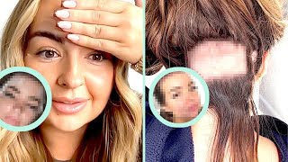 Bullied Into Getting A Hair Transplant 😟 Full Forehead Reduction Surgery Process | Tyla