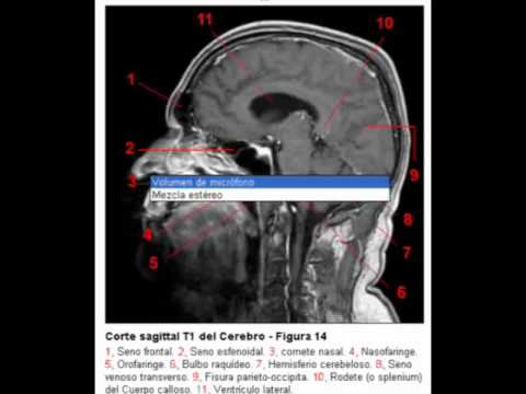 Resonancia que cerebral es magnetica