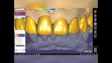 Exocad designing temporary bridge