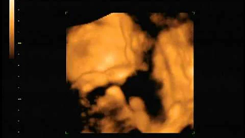 31 week 3d ultrasound part 2