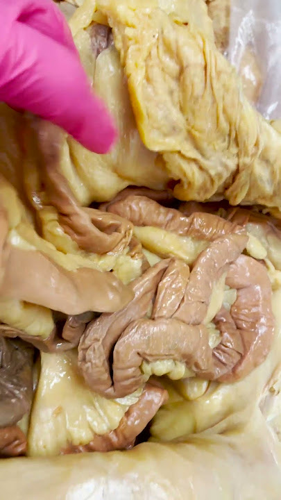 Extreme Amounts of Visceral Fat