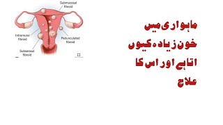 heavy Menustral Bleeding/heavy bleeding in periods/polys/fibroids/endometriosis in Urdu