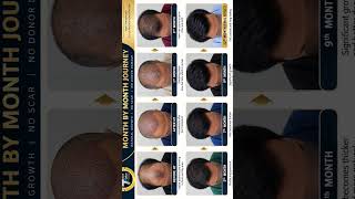 Hair Transplant Results Month by Month | 12-Month Hair Growth Journey | Rajkumar