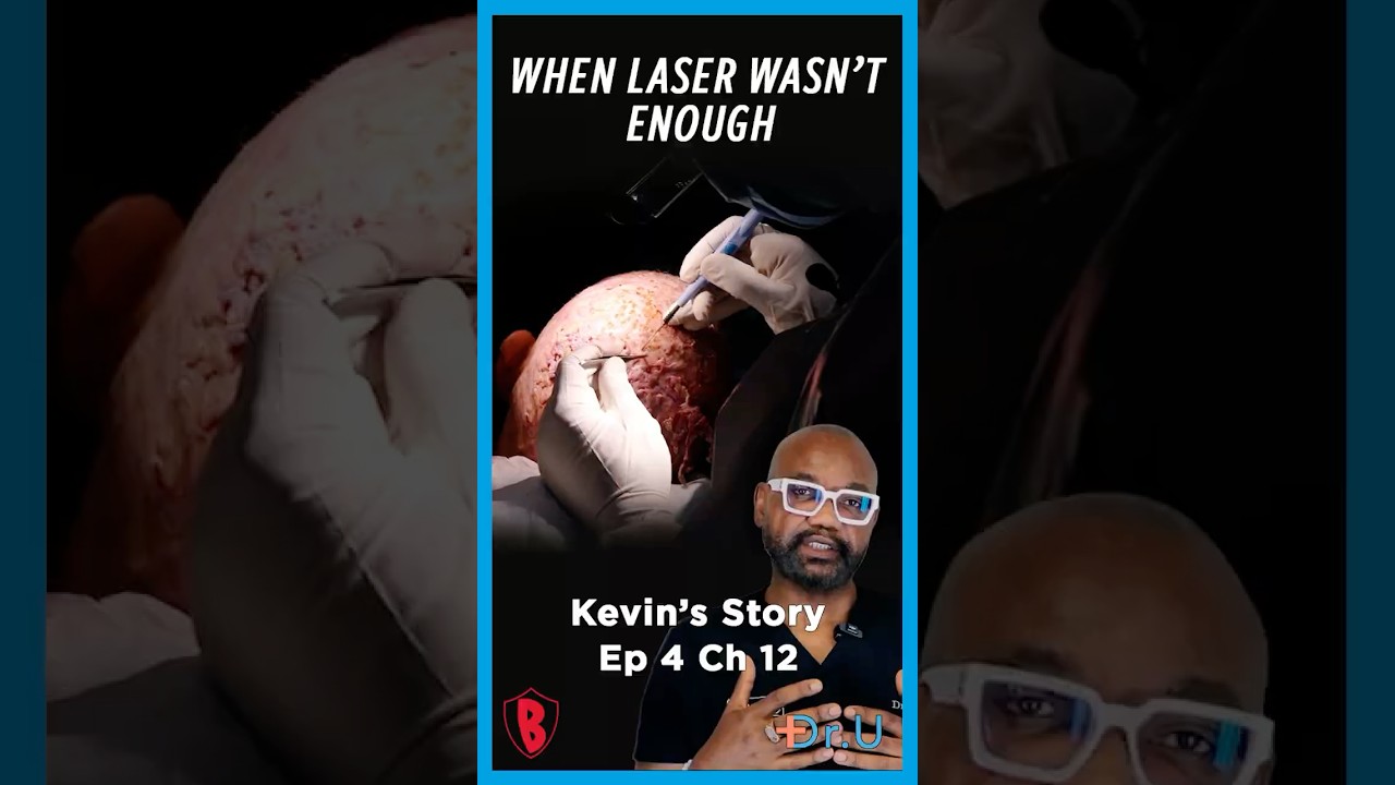 When Laser Treatment Wasn’t Enough for Dissecting Cellulitis