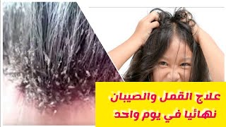 علاج القمل والصيبان نهائيا من شعر الرأس بطريقة صحية عند الأطفال والكبار #pouxid