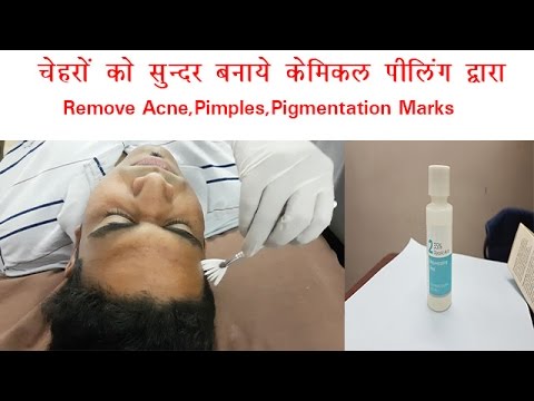 Face Glowing Treatment |Remove Acne, Pimples Marks By Peeling |