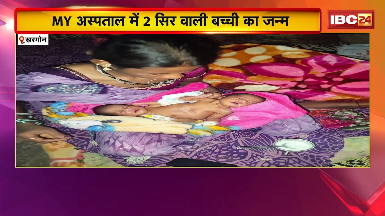 Khargone News : MY अस्पताल में 2 सिर वाली बच्ची का जन्म। दोनों बच्चियों का शरीर एक और दो सिर