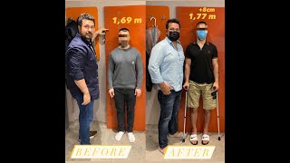 How I went from 1.69 m ➡️1.77 m+8 cm more height in 1surgery.My limb lengthening surgery experience.