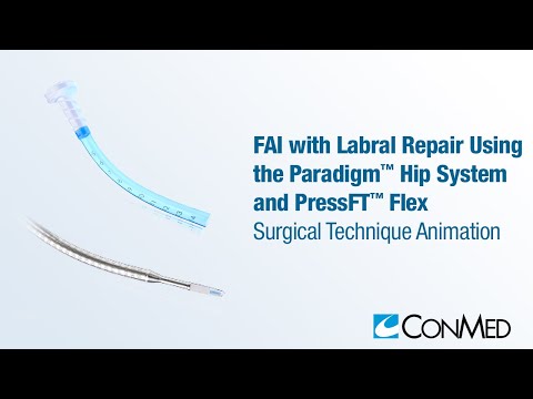 FAI and Labral Repair Using the Paradigm™ Hip System and PressFT™ Flex Anchor - CONMED Animation