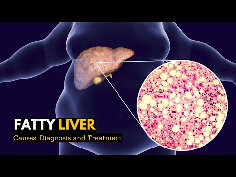 Video: Způsobuje hepatitida steatózu jater?