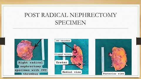 Robotic radical nephrectomy and level 2 IVC thrombectomy - Urology JIPMER