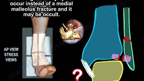 Ankle Fractures - Everything You Need To Know - Dr. Nabil Ebraheim