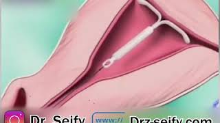 نحوه گذاشتن IUD | متخصص زنان و جراح زیبایی واژن | دکتر زهرا سیفی | How to put an IUD
