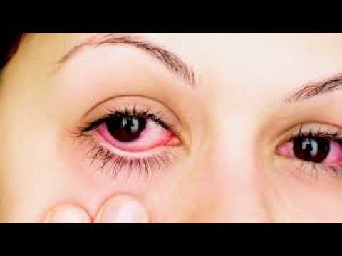 Conjuntivitis , remedios caseros para el tratamiento del ojo rosado