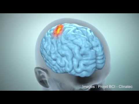 Vidéo: Utilisation D'une Interface Cerveau-machine Pour Contrôler Un Exosquelette Hybride Du Membre Supérieur Lors De La Rééducation De Patients Souffrant De Troubles Neurologiques