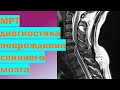 МРТ диагностика повреждения спинного мозга
