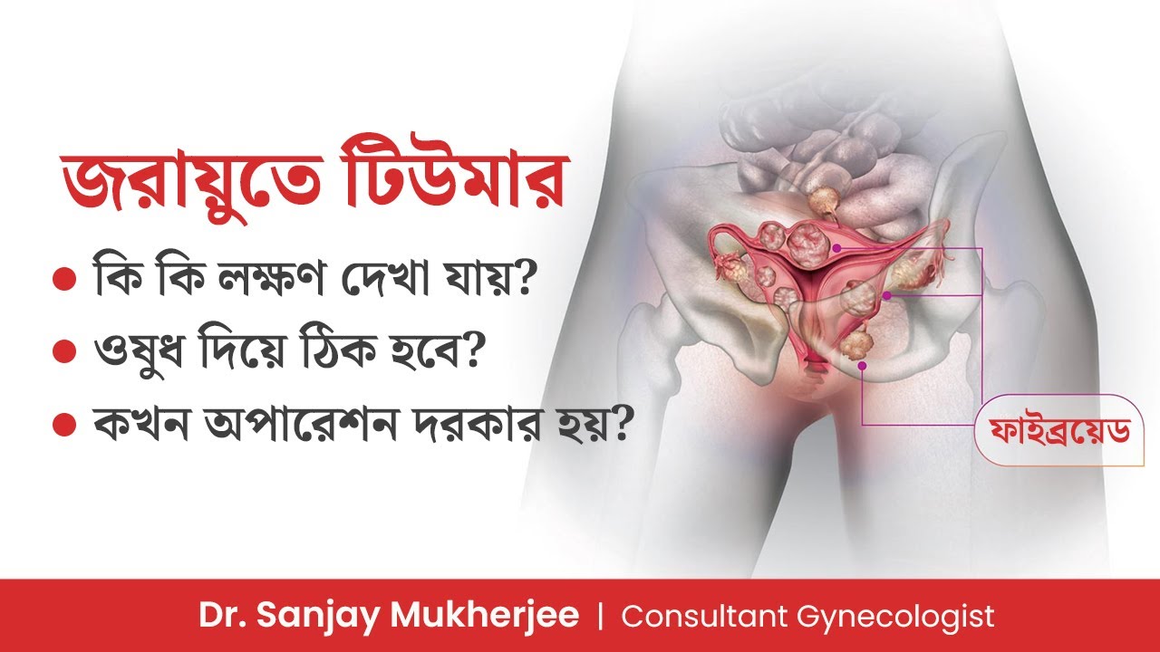 জরায়ুর টিউমারের লক্ষণ ও চিকিৎসা | ওষুধে কি ফাইব্রয়েড ঠিক হয়? Uterine Fibroids Symptoms & Treatment