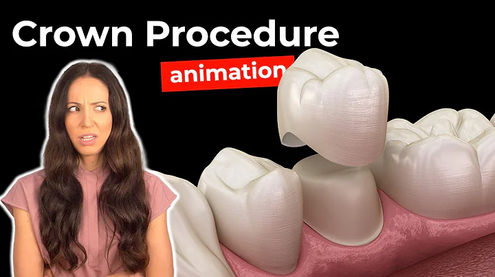 Dental Crown Procedure at the Dentist