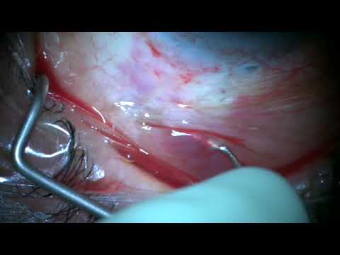 XEN gel stent needling with 5FU