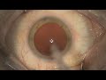 Toric lens implant. How to align the toric lens implant using ToricCam app and axis marker.