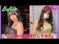 【脂肪吸引】二の腕before&after、全部公開!