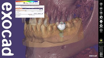 exocad Quick Guide: Using the Immediate Load feature in combination with exoplan