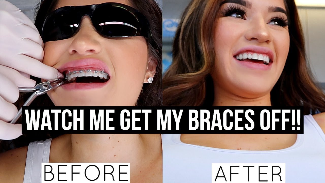 How Can I Get Braces mattpdesign How Can I Get Braces mattpdesign