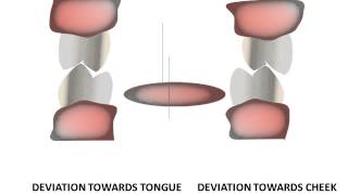 Introduction to equilibration Occlusal interferences