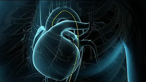 Coronary Angioplasty Surgery | Balloon Angioplasty | Nucleus Health