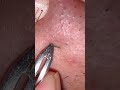 Plucking grooming beard #beardcare #asmrskincare #blackheads #satisfying #plucking #extraction