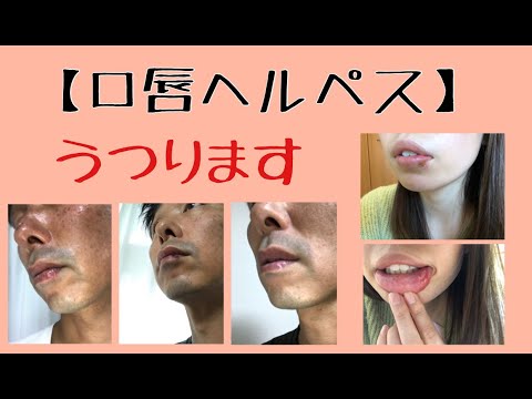 【口唇ヘルペス治し方】口唇ヘルペスの原因・症状・治療法〜唇が痛い・口唇ヘルペスはうつります〜【千葉市整体院「快」】