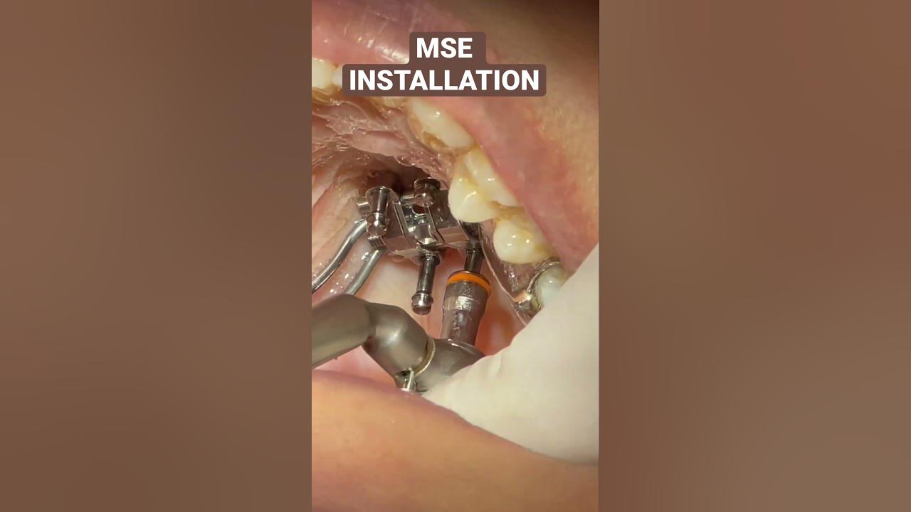 MSE expander installation using the mini screw driver and the ratchet