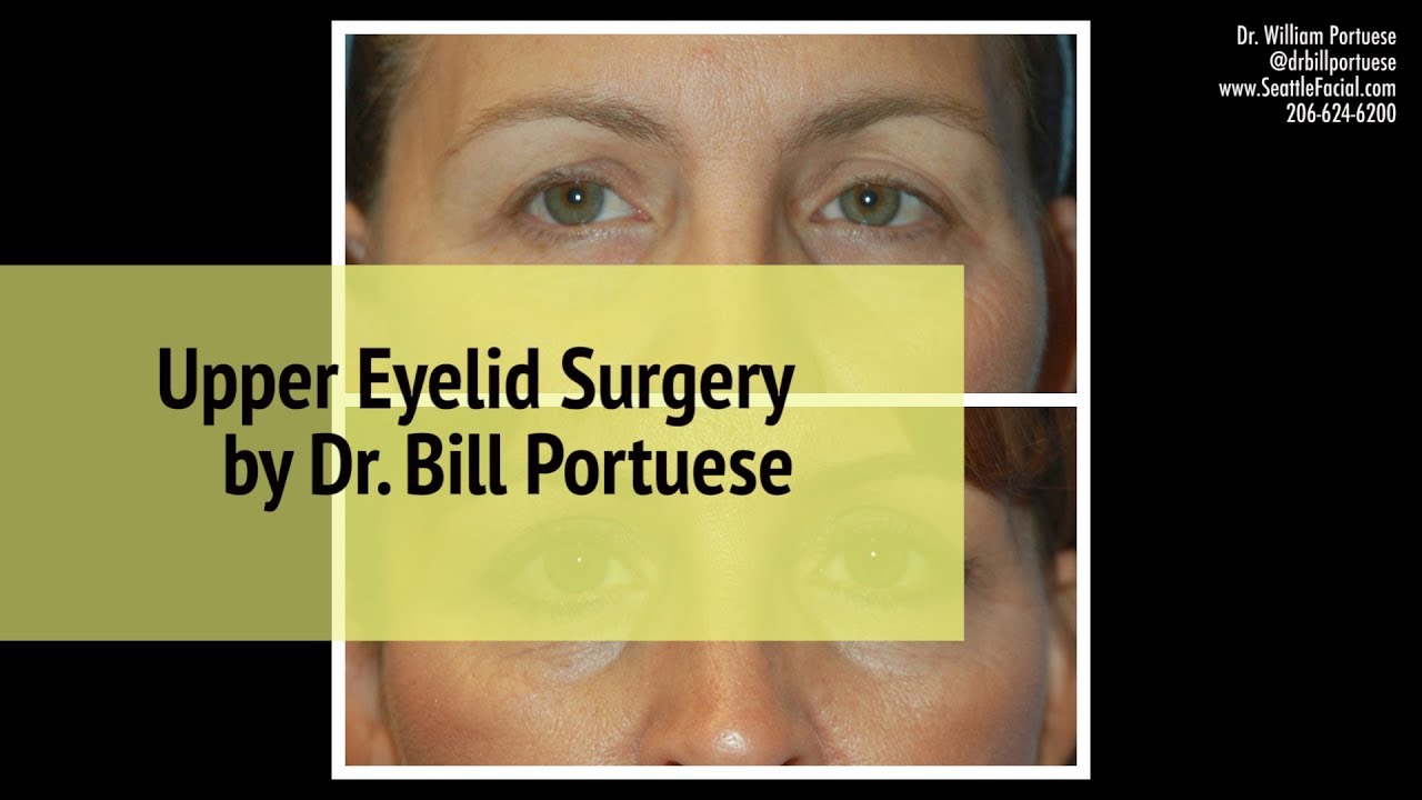 👁️Upper Eyelid Surgery for All Types of People (Blepharoplasty) 👁️ Eyelid Rejuvenation in Seattle