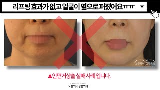안면거상재수술은 재거상 경험이 풍부한 김창연원장! (★더보기란 필독★)