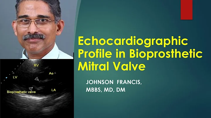 Echocardiographic profile of bioprosthetic mitral valve