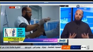 تقنية جديدة لعلاج الدوالي  بدون جراحة